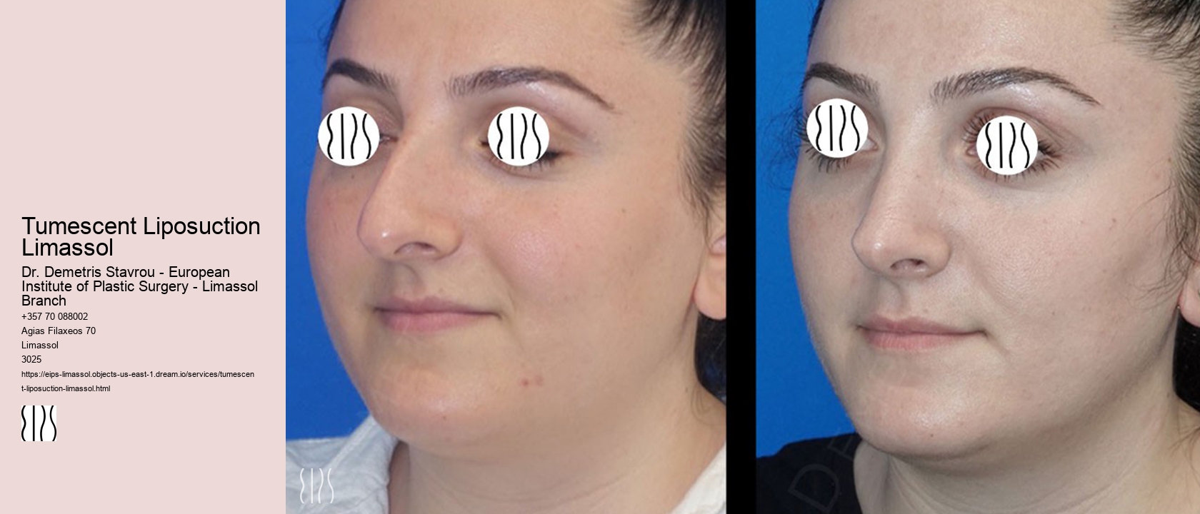 Tumescent Liposuction Limassol